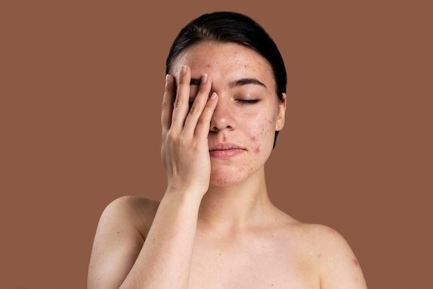 Wajah dapat mengalami iritasi akibat makeup tidak dibersihkan