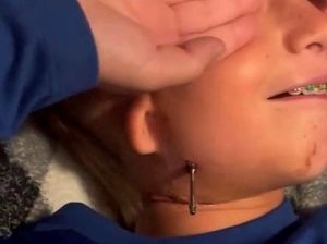 Idap Penyakit Langka, Dagu Bocah Ini Dipasang Mur Agar Bisa Makan