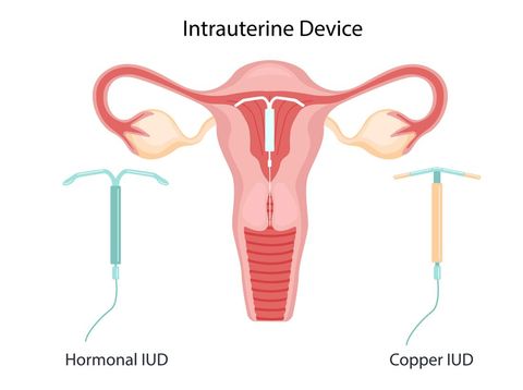 IUD