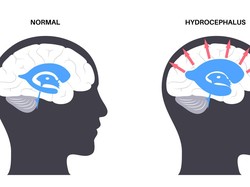 Hidrosefalus Adalah Penumpukan Cairan di Otak, Kenali Penyebab dan Gejalanya