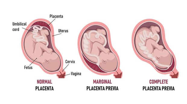 Ilustrasi plasenta previa