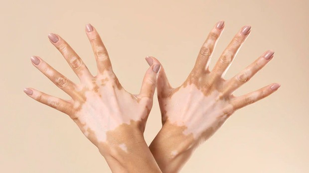 Perawatan penyakit vitiligo/Foto: Freepik/Freepik Perawatan penyakit vitiligo/Foto: Freepik/Freepik