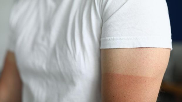 Close-up of man wearing white shirt with red mark of bad suntan. Basic colour of outfit. Strip with difference. Failed tan. Male arm with burnt skin. Summer rest concept