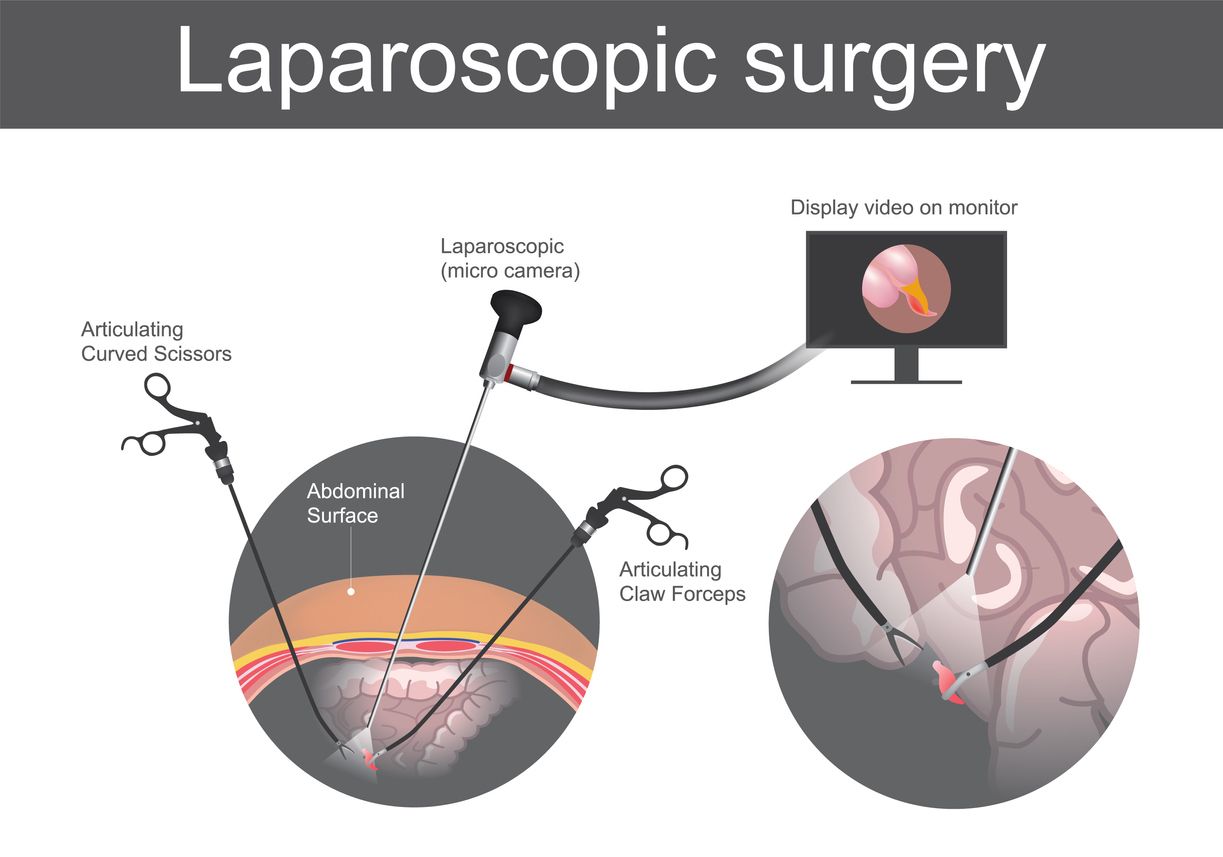 Ilustrasi operasi laparoskopi