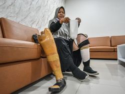 Senyum Semringah Imtihanah Penyintas Kanker Tulang Surabaya Dapat Kaki Palsu