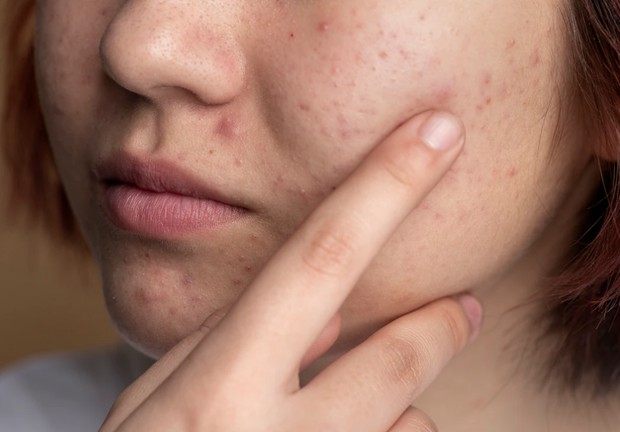 Mengatasi kulit berjerawat/foto: freepik.com/freepik Mengatasi Kulit Berjerawat