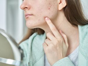 8 Cara Mengobati Jerawat Batu yang Ganggu Kecantikan Kulit 8 Cara Mengobati Jerawat Batu yang Ganggu Kecantikan Kulit