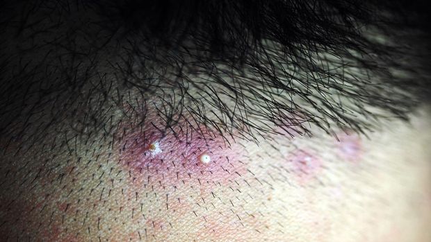 inflamed pus pimples on head scalp, hair follicles acne
