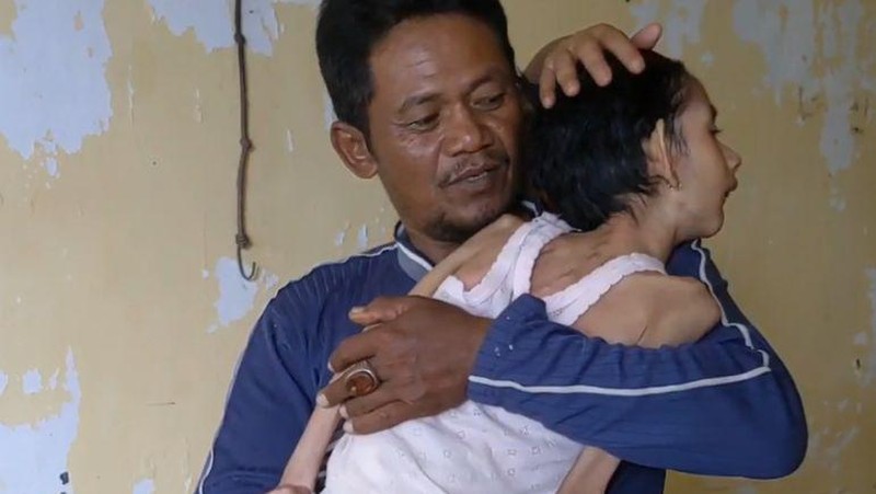 Mari Bantu Lissa, Anak Buruh Bangunan yang Lemas dan Kurus karena Gizi Buruk