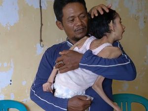 Mari Bantu Lissa, Anak Buruh Bangunan yang Lemas dan Kurus karena Gizi Buruk