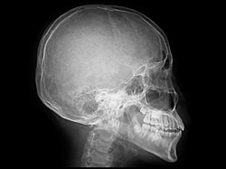 Viral! TikToker Kaget Tulangnya Hitam Gegara Obat Jerawat