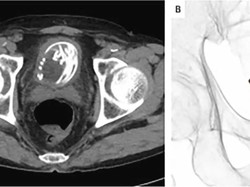 Ngilu! Pria Ini Nekat Masukkan Tali ke Penis, Berujung Nyangkut di Kandung Kemih