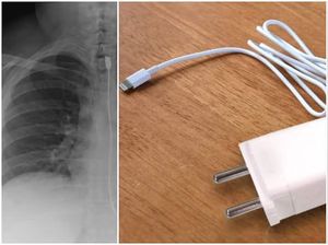 Alami Gangguan Makan Langka, Wanita Ini Doyan Makan Kabel Charger