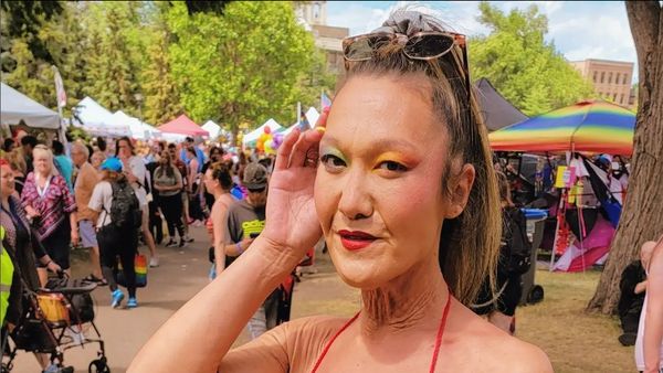 8 Potret Model dengan Kondisi Langka, Kulit Keriput di Usia 31 Tahun