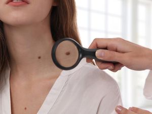 5 Cara Menghilangkan Tanda Lahir Menurut Ahli, Ada Obat hingga Operasi