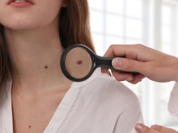 5 Cara Menghilangkan Tanda Lahir Menurut Ahli, Ada Obat hingga Operasi