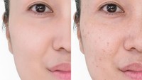 Serum untuk Menghilangkan Bekas Jerawat, Ini 6 Kandungan Aktif Paling Efektif