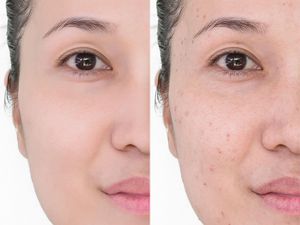 7 Cara Memudarkan Bekas Jerawat Secara Alami dan Efektif