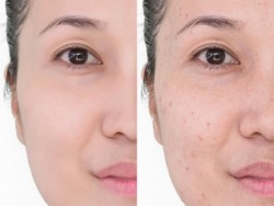 7 Cara Memudarkan Bekas Jerawat Secara Alami dan Efektif