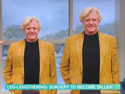 Cerita Pria Operasi Pasang Paku Peninggi Badan di Kaki, Biayanya Rp 2,4 M