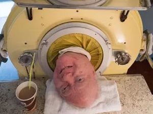 Akhir Kisah Paul Alexander, Manusia Terakhir yang Hidup di Paru-paru Besi