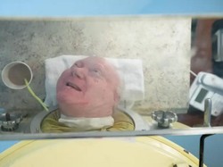 Pria Berparu-paru Besi Meninggal di Usia 78 Tahun