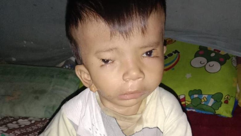 Kabar Baik dari Afriliam, Bocah di Jambi yang Alami Kelainan Wajah