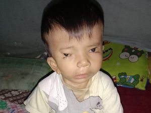 Kabar Baik dari Afriliam, Bocah di Jambi yang Alami Kelainan Wajah