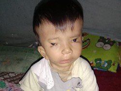 Kabar Baik dari Afriliam, Bocah di Jambi yang Alami Kelainan Wajah