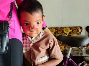 Mari Bantu Dilan, Bocah Penderita Tumor Hidung di Lampung Timur