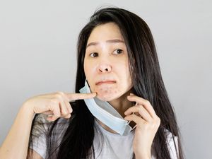 Penyebab Muncul Jerawat di Dagu, Ini Penjelasan Dermatolog! Penyebab Muncul Jerawat di Dagu, Ini Penjelasan Dermatolog!