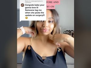 Ukuran Payudara 44H Bikin Sulit Napas, Wanita Ini Operasi Berbiaya Rp 250 Juta