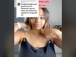 Ukuran Payudara 44H Bikin Sulit Napas, Wanita Ini Operasi Berbiaya Rp 250 Juta