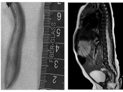 Kasus Langka, Bayi di Meksiko Lahir dengan Ekor Sepanjang 5,7 Cm
