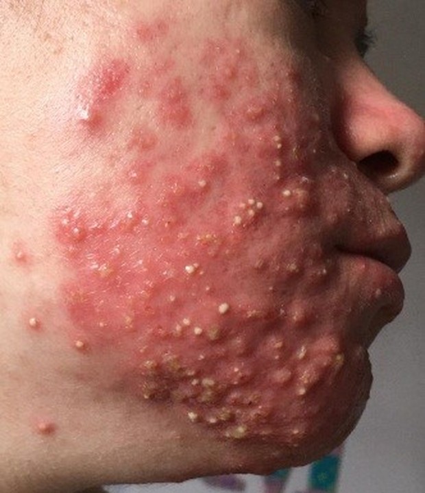 Jerawat fulminans/foto: medmalay.com Jerawat fulminans