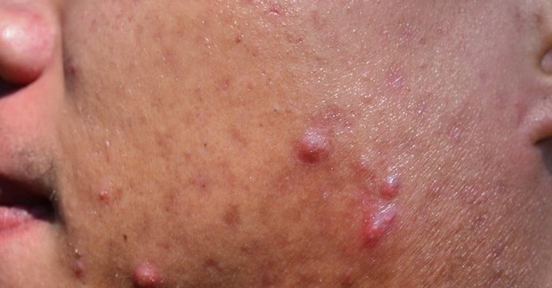 Jerawat kistik (cystic acne)/foto: thelist.com Jerawat kistik (cystic acne)