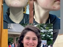 Viral Cuci Muka Pakai Sampo Anti Ketombe Bisa Atasi Jerawat, Ini Kata Dokter