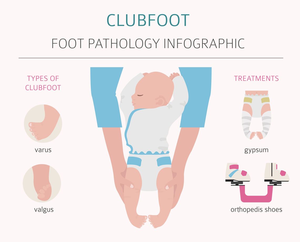Infografis Clubfoot