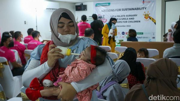54 Anak di Jabodetabek Jalani Operasi Bibir Sumbing