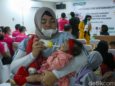 54 Anak di Jabodetabek Jalani Operasi Bibir Sumbing