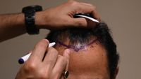 Transplantasi Rambut Menjamur di India hingga Berujung Maut