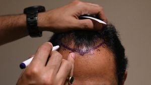 Transplantasi Rambut Menjamur di India hingga Berujung Maut
