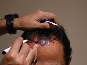 Transplantasi Rambut Menjamur di India hingga Berujung Maut Transplantasi Rambut Menjamur di India hingga Berujung Maut