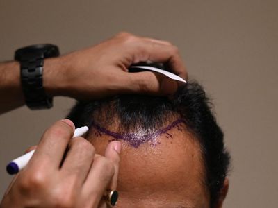 Transplantasi Rambut Menjamur di India hingga Berujung Maut