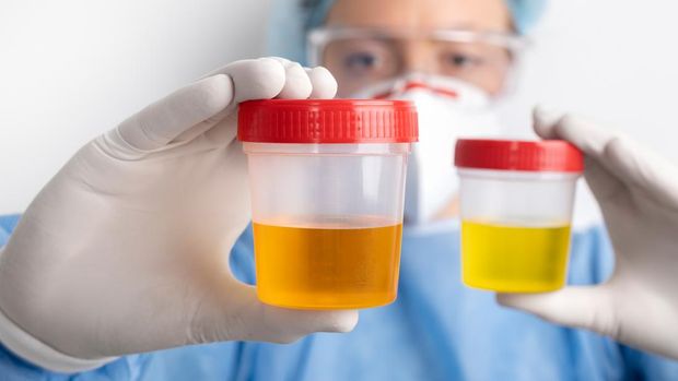 Potret warna urine yang berbeda.