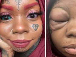 Viral Wanita Nyaris Buta gegara Nekat Tato Bola Mata