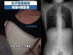 Tersedak Saat Makan, Wanita Bertubuh Kurus Ini Tulang Rusuknya Patah