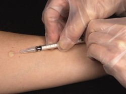 Apa Itu Tes Mantoux? Kenali Fungsi dan Cara Membacanya