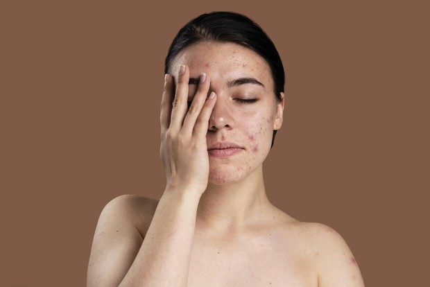 Tanda skin barier rusak