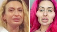 Foto: Transformasi Model dengan Pipi Terbesar, Before-After Suntik Filler